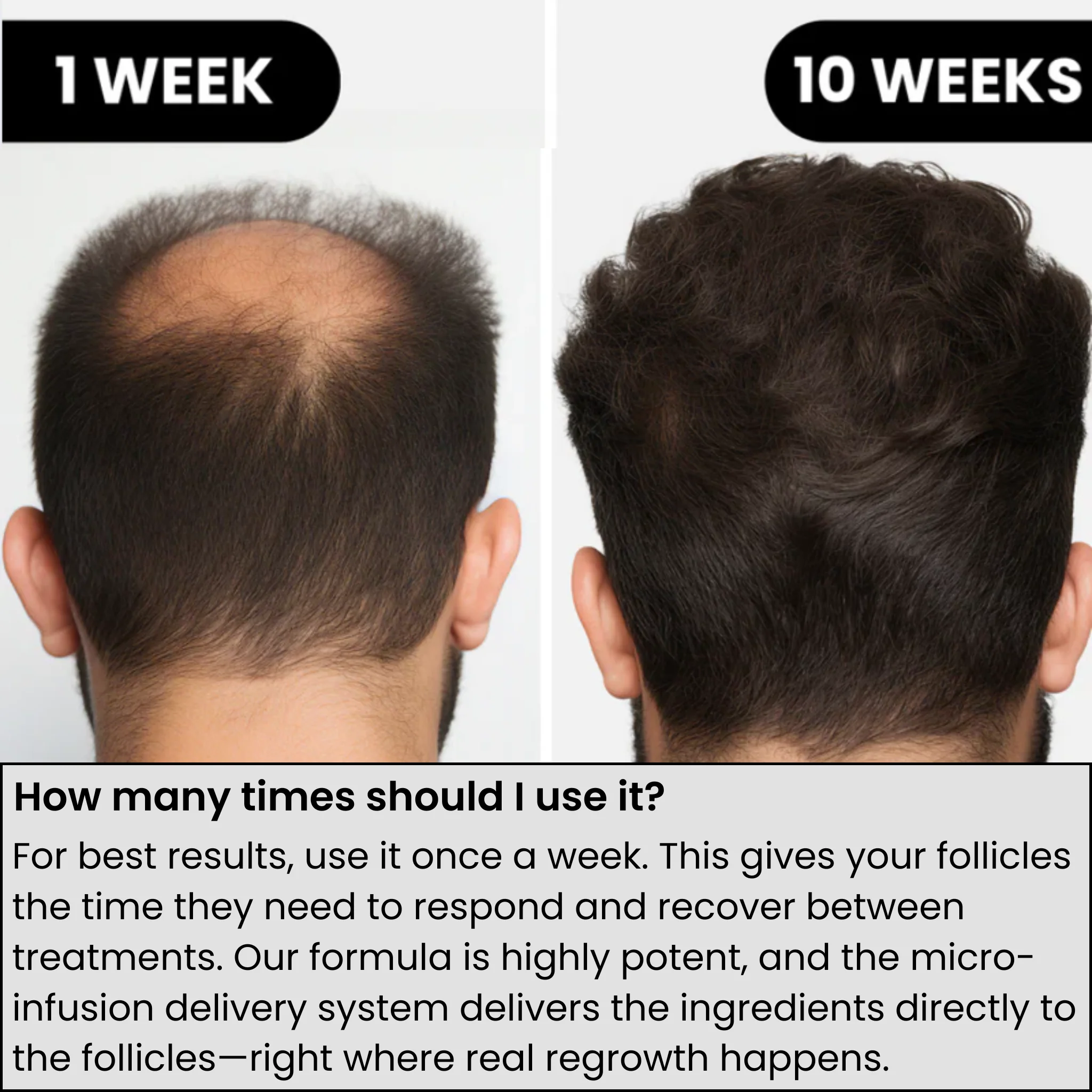 AlphaInfuse™ Hair Growth System - Image 3