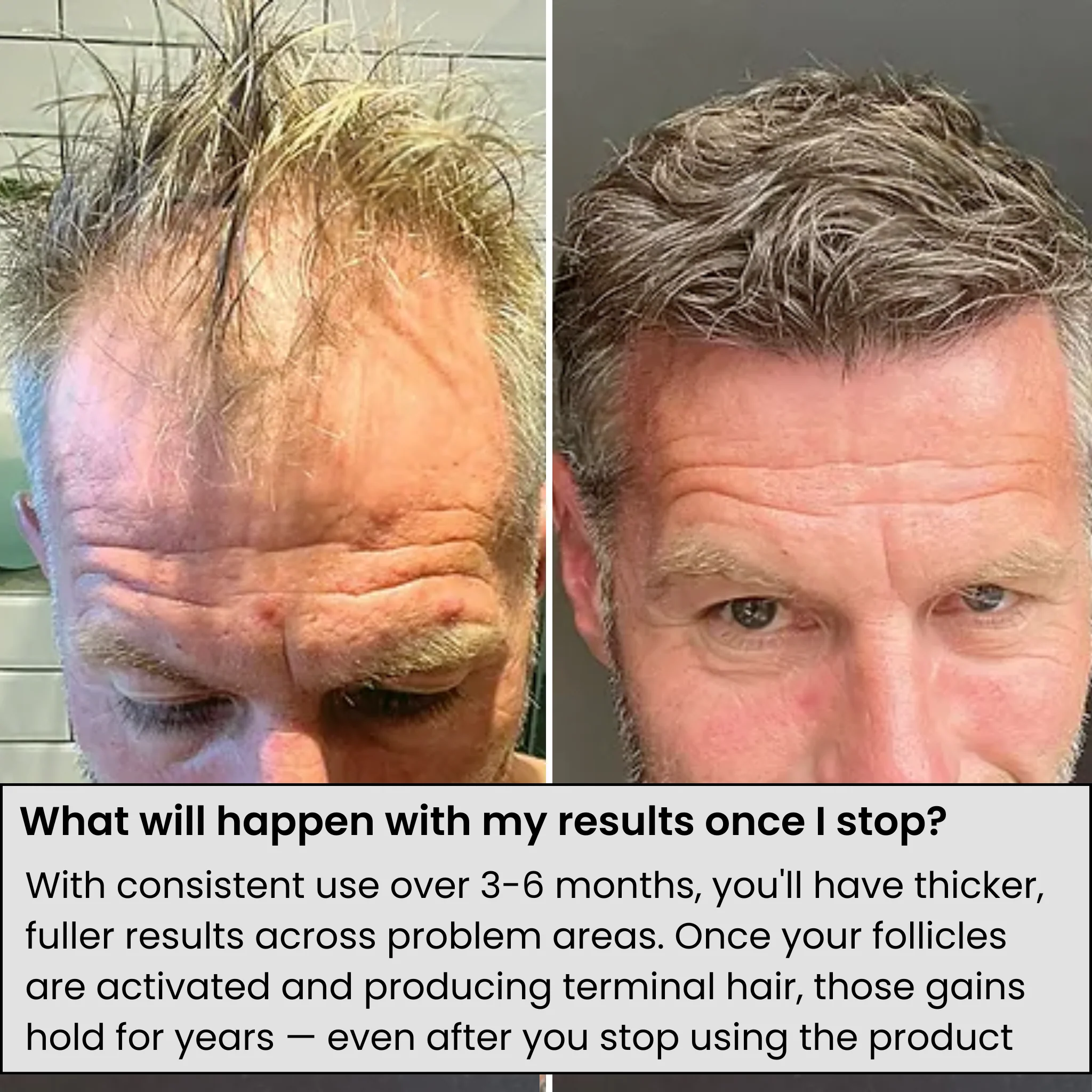 AlphaInfuse™ Hair Growth System - Image 7