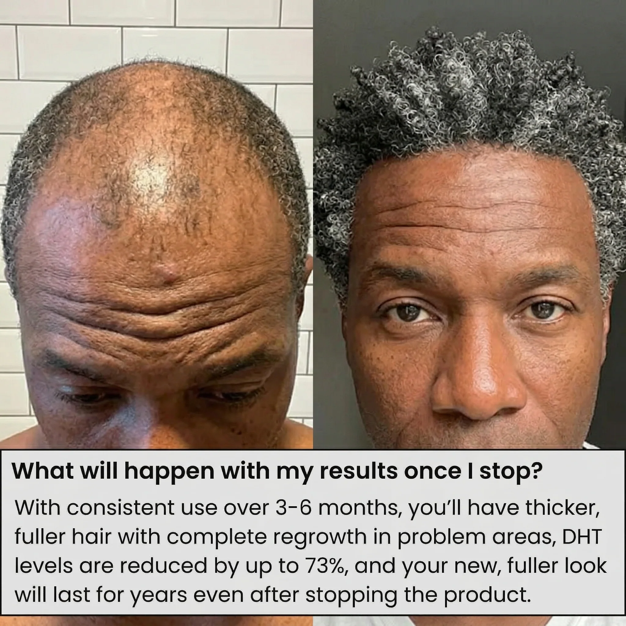AlphaInfuse™ Hair Regrowth System - Image 6